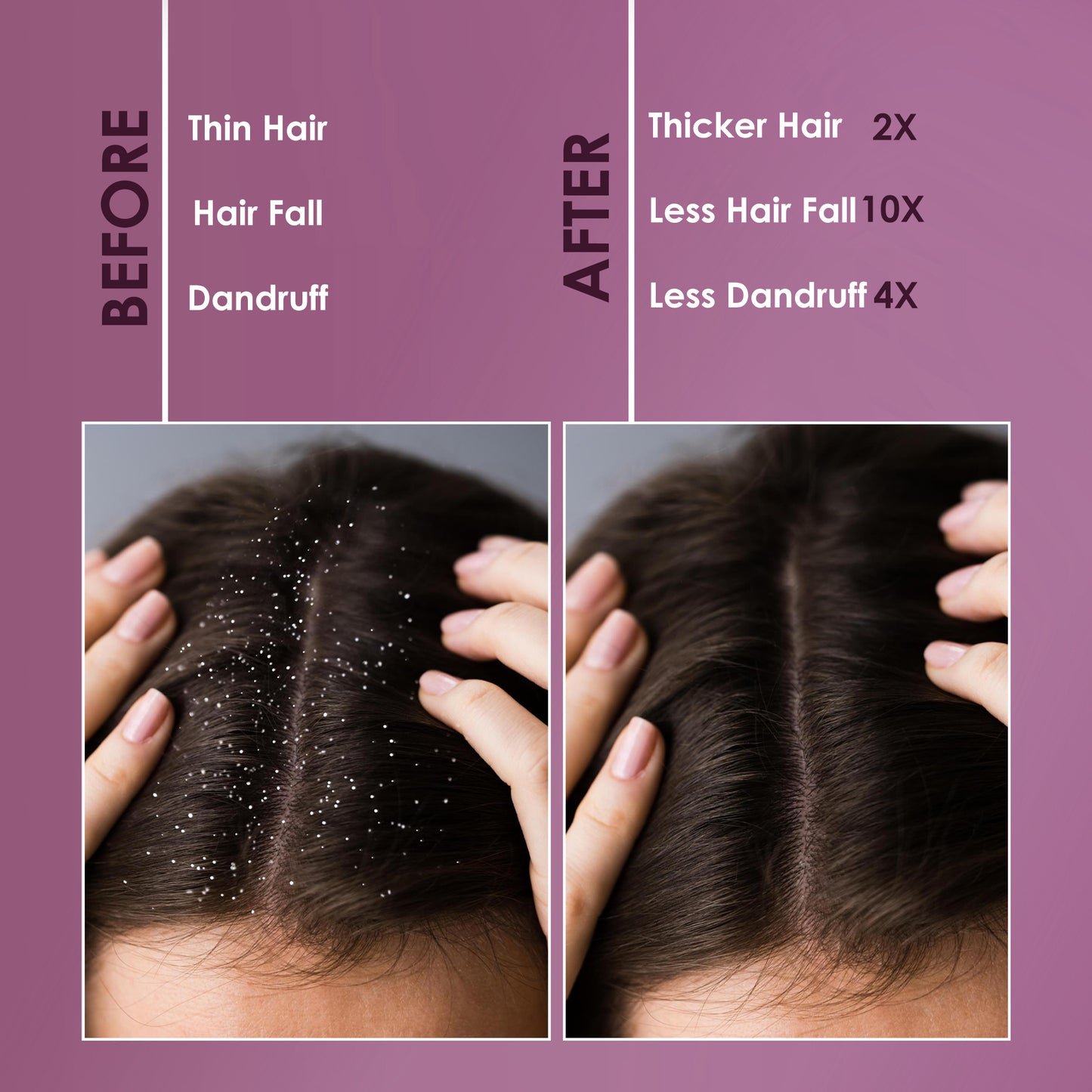 Audox Seborrhea Shampoo - (For Dandruff)